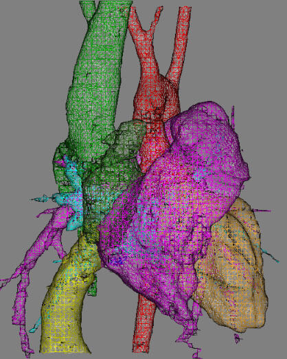 heart-mapping-technique-safely-guides-catheter-repair-of-arrhythmia